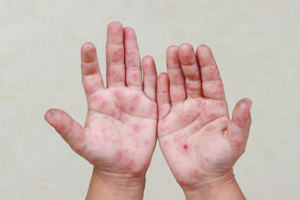 解封後直線飆升！每週萬人感染腸病毒醫師籲勤洗手保健康