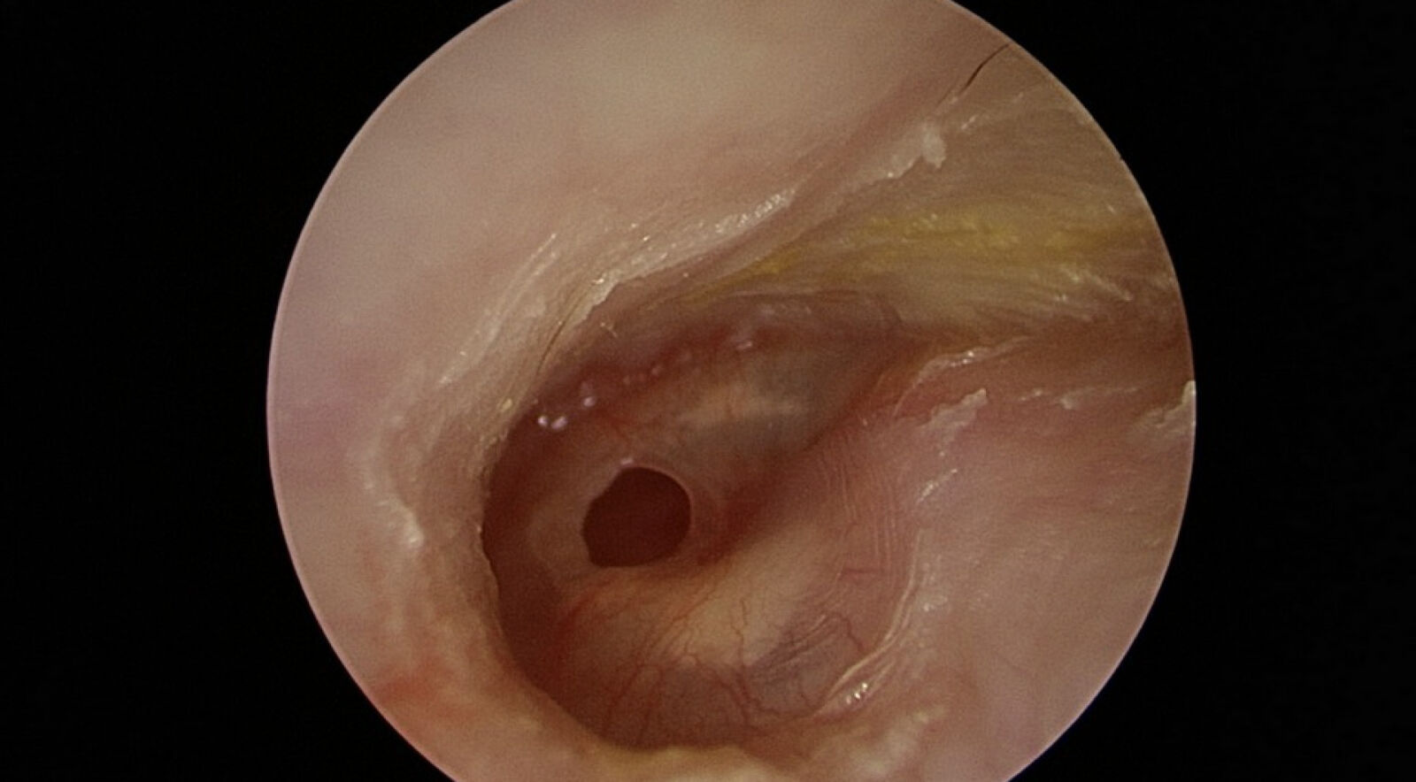 婦人接連感冒竟「聽不清、耳流湯」 醫師一看耳膜破大洞了 15
